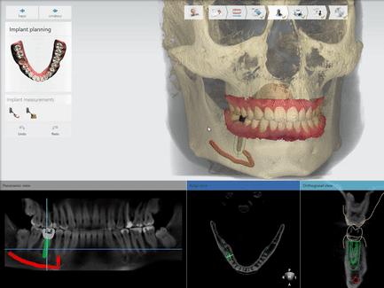 implant dentar ghidat 3d digital